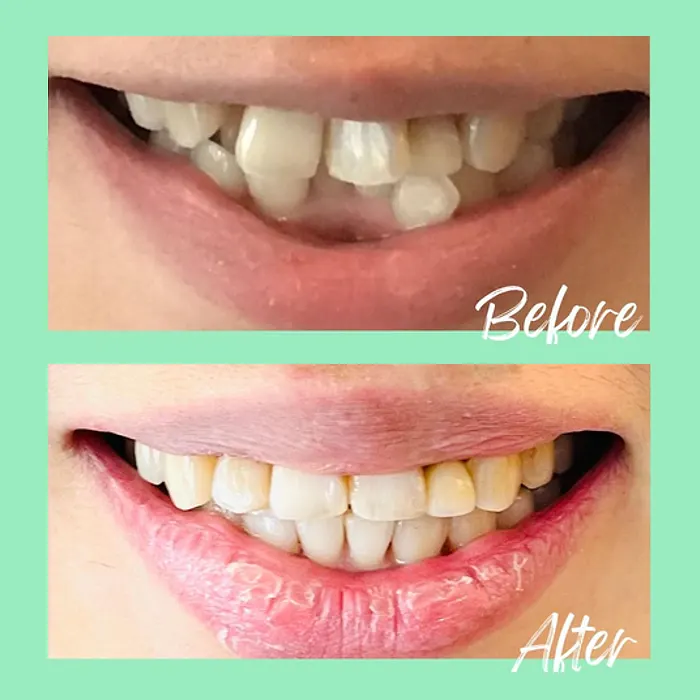 A real Invisalign before-and-after result at Mint Leaf Dentistry