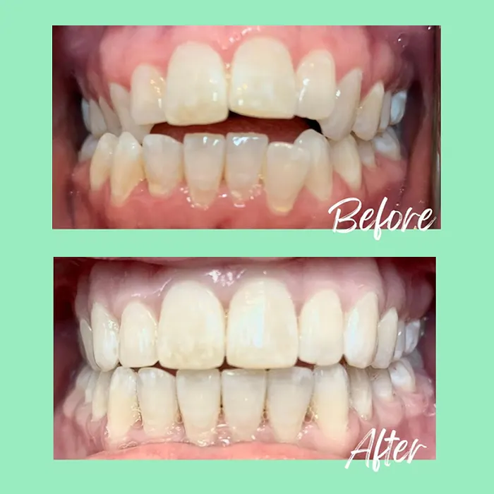 A real Invisalign before-and-after result at Mint Leaf Dentistry