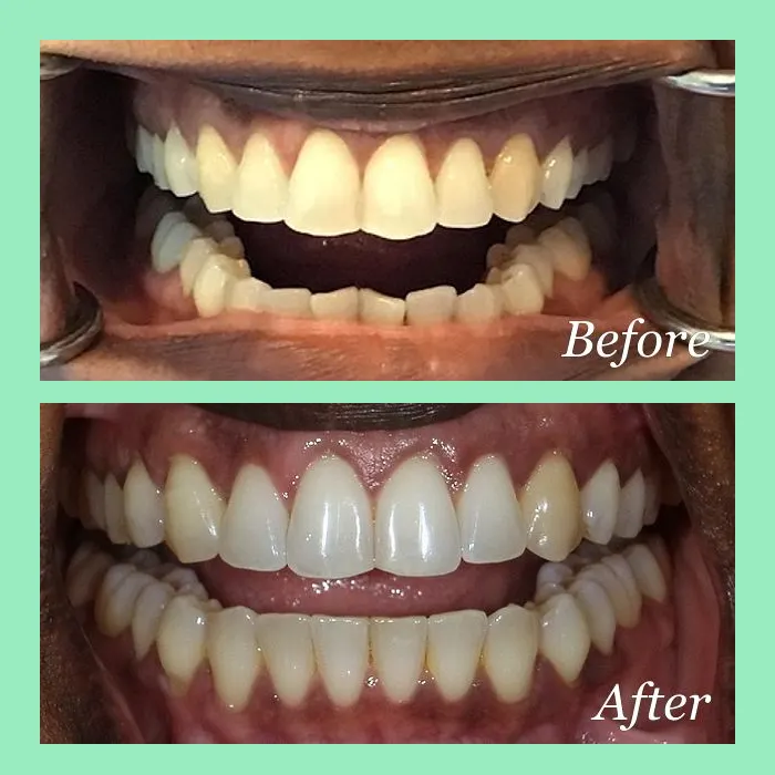 A real Invisalign before-and-after result at Mint Leaf Dentistry