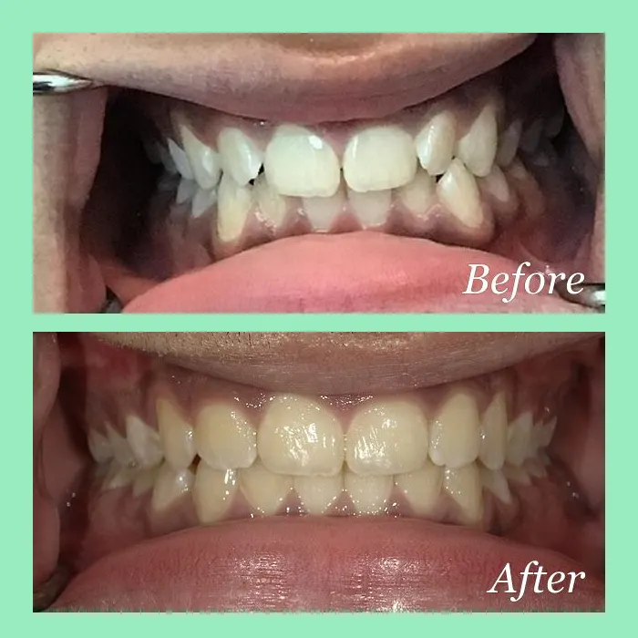 A real Invisalign before-and-after result at Mint Leaf Dentistry