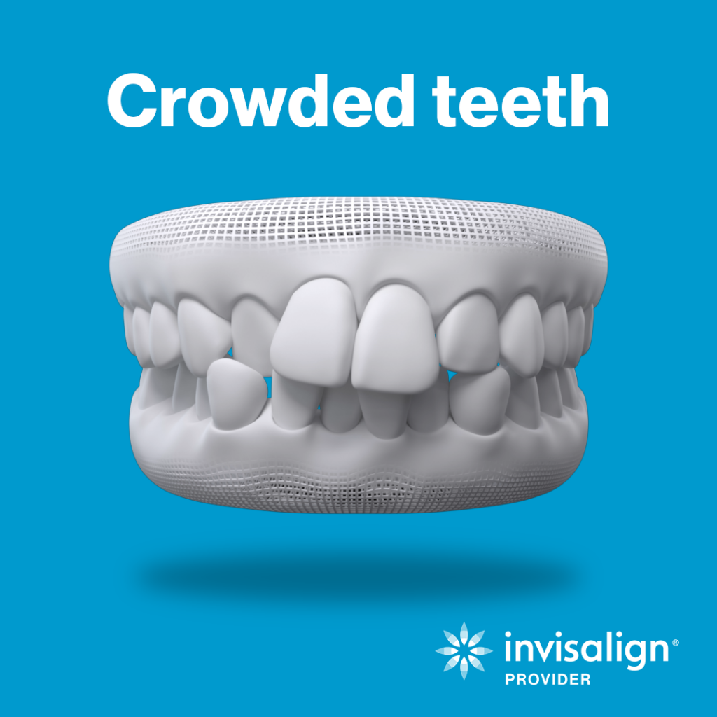 Crowded teeth example