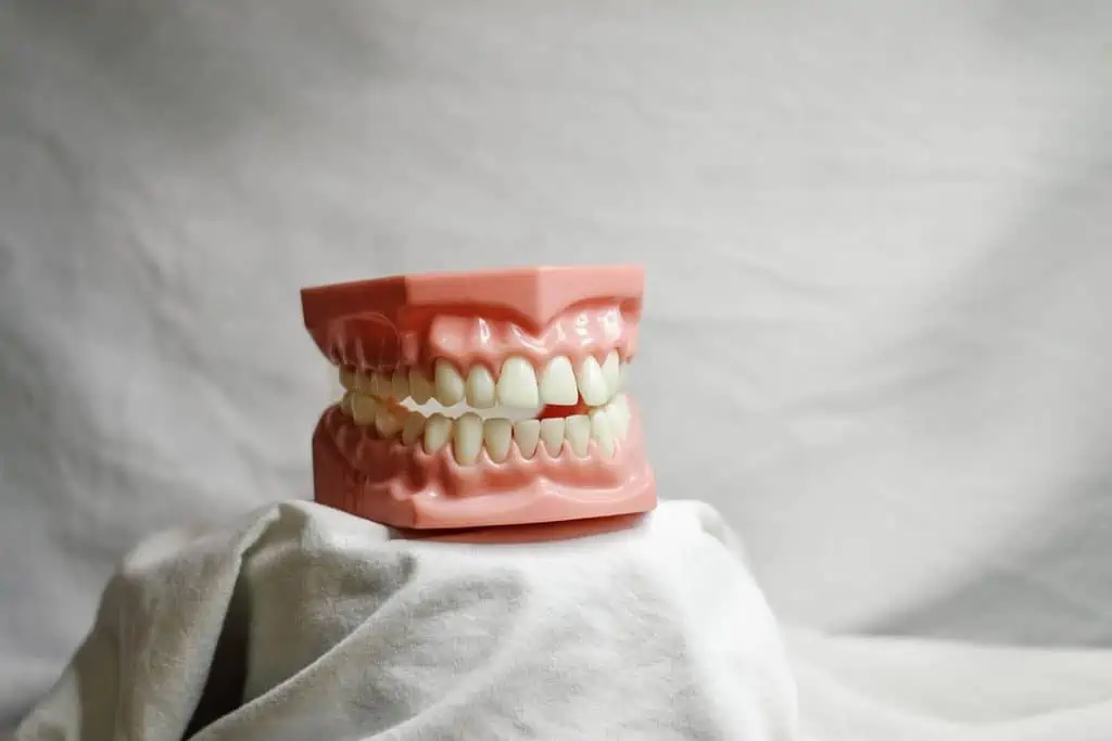 Teeth mold used at a dentist office for Invisalign vs braces